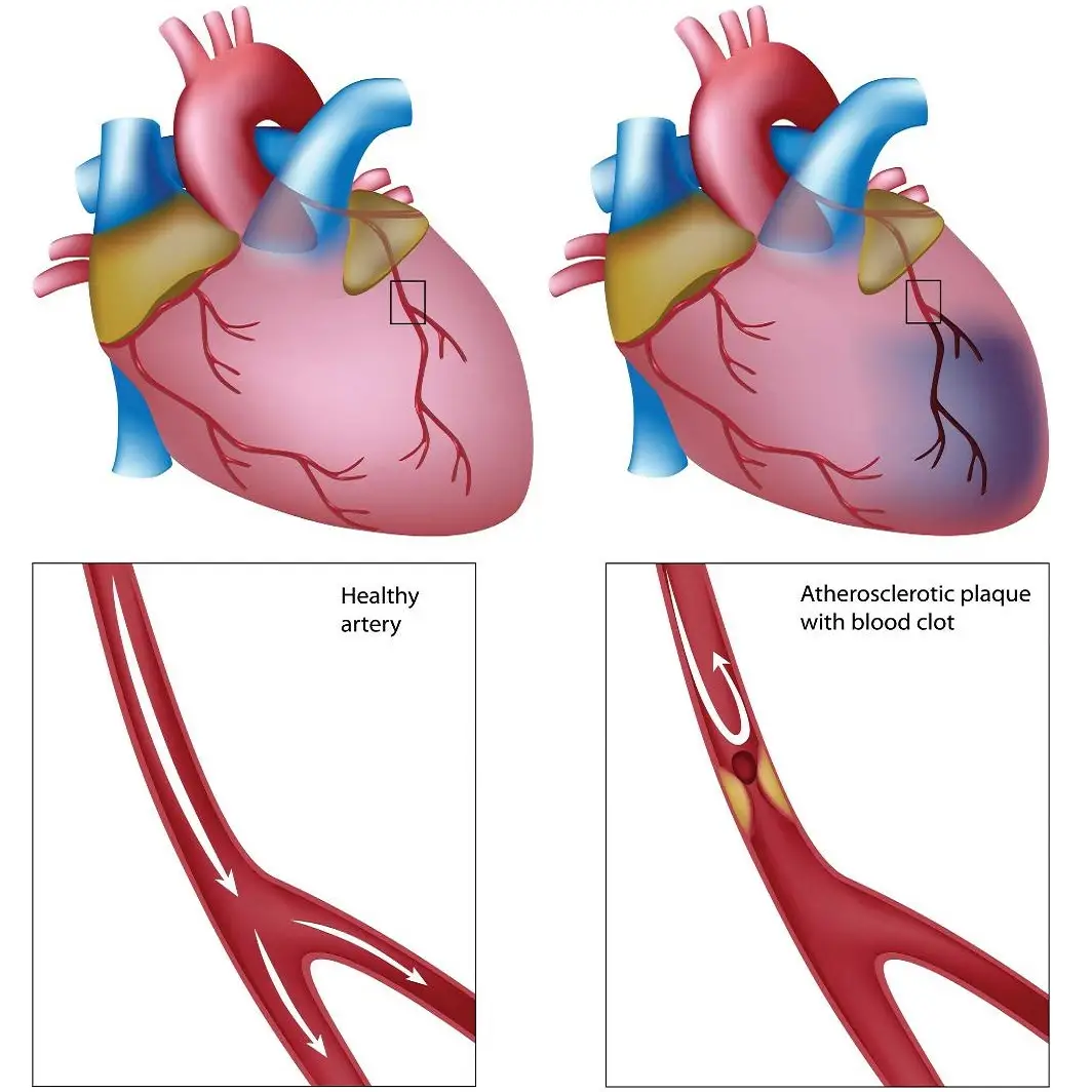 chapter-2-inferior-wall-myocardial-infarction-thoracic-key